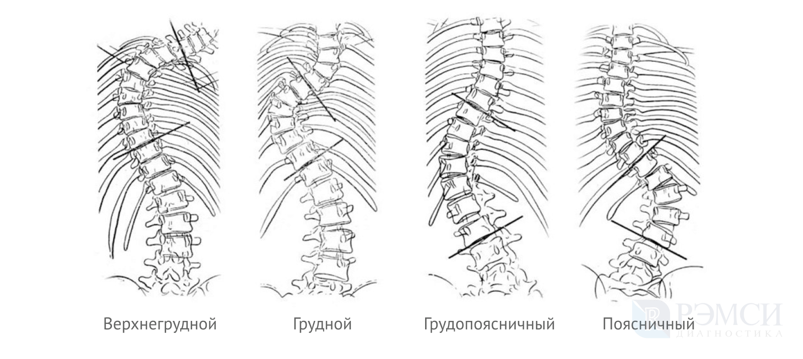 Степени деформации позвонков. S образный сколиоз 1 степени по чаклину. Сколиотическая деформация грудного отдела позвоночника. Кифосколиоз грудного отдела позвоночника. Сколиотическая деформация поясничного отдела позвоночника.