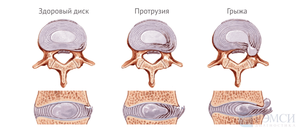 Операция по замене межпозвоночного диска