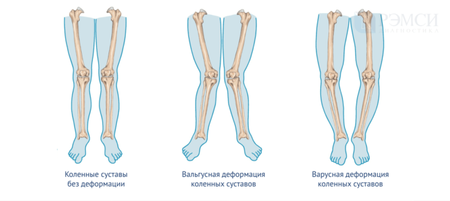 Деформация коленного сустава у взрослого фото