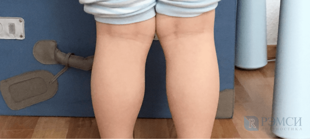 article img 2 deformaciya kolennogo sustava