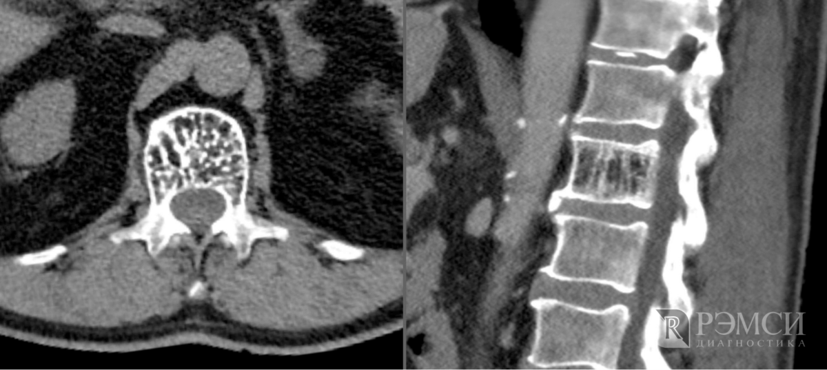 Гемангиома l2 позвонка фото