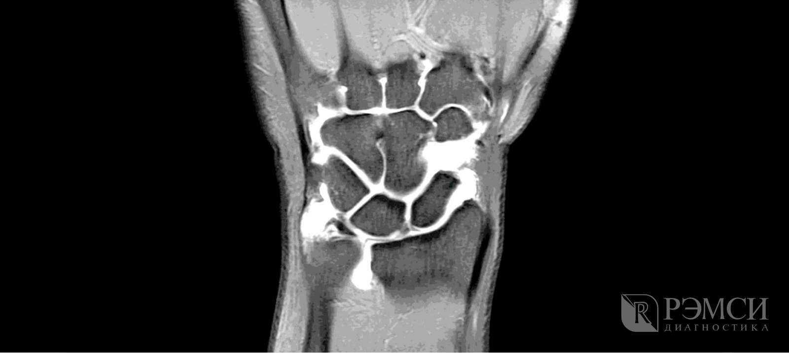 Гигрома рентген. Мрт лучезапястного сустава. Анатомия лучезапястного сустава мрт. Артрит лучезапястного сустава мрт. Синовит лучезапястного сустава мрт.