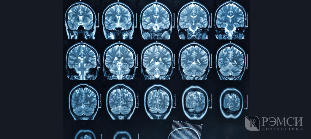 Как проходит исследование головного мозга: пример снимка МРТ
