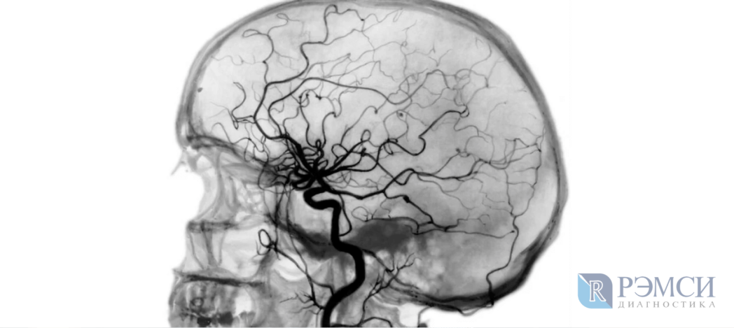 Как проходит исследование головного мозга: ангиография