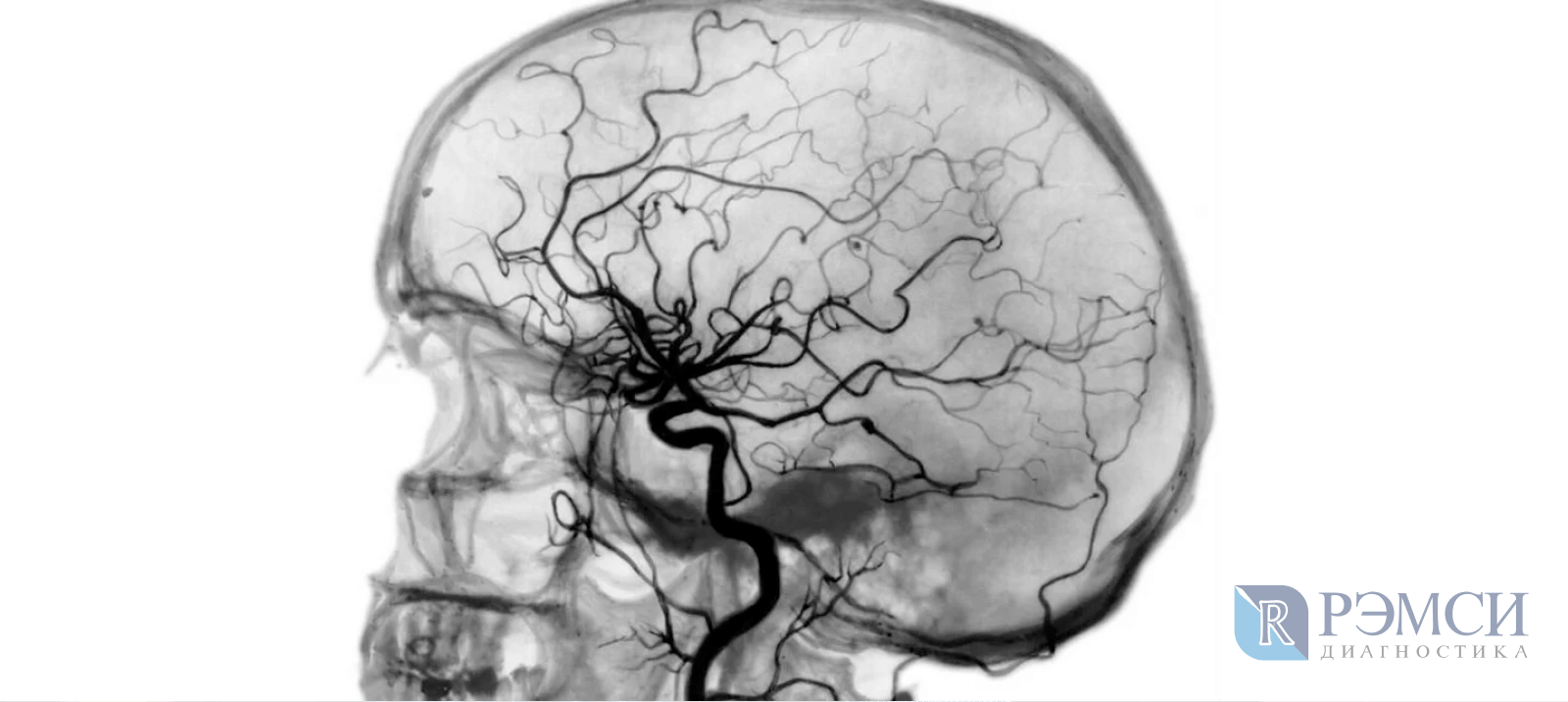 Ангиография головного мозга