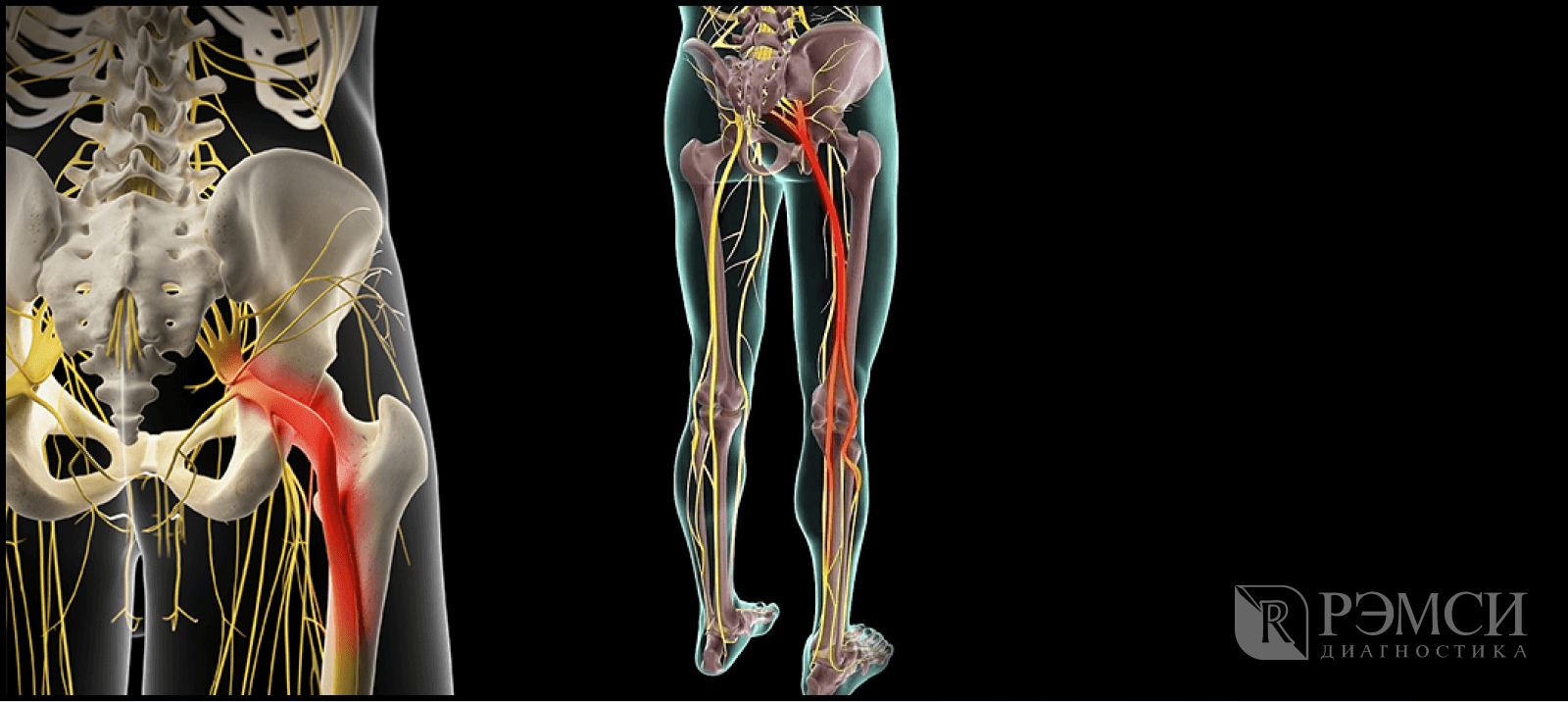 Защемление нерва в крестце. Седалищный нерв. Ишиас воспаление седалищного. Защемление седалищного нерва.