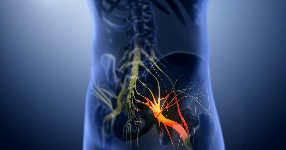 Защемление седалищного нерва: симптомы