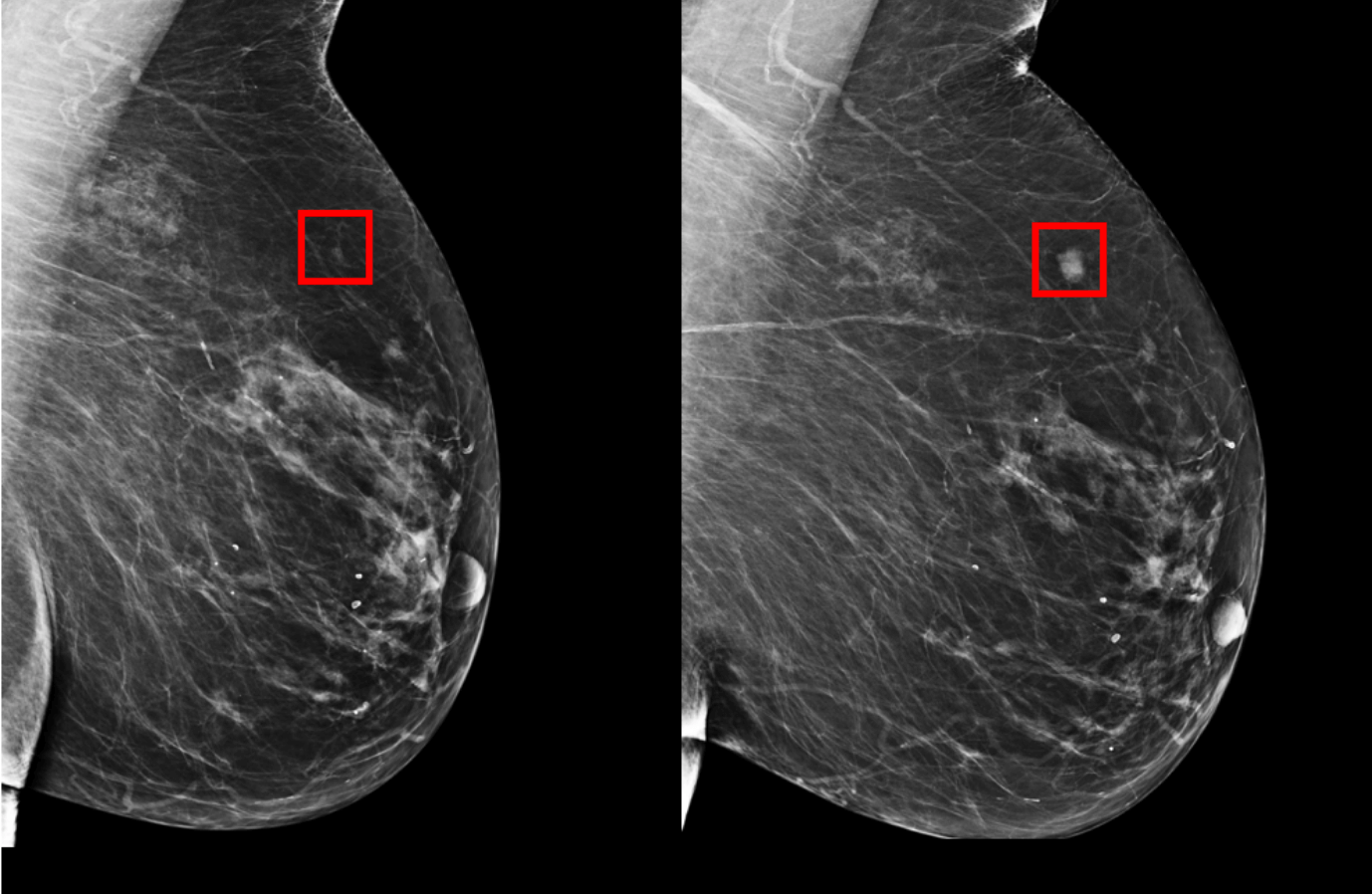 признаки опухоли в груди у женщин фото 106