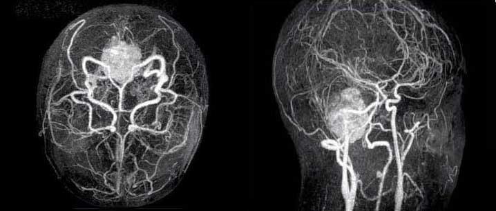Магнитно резонансная ангиография